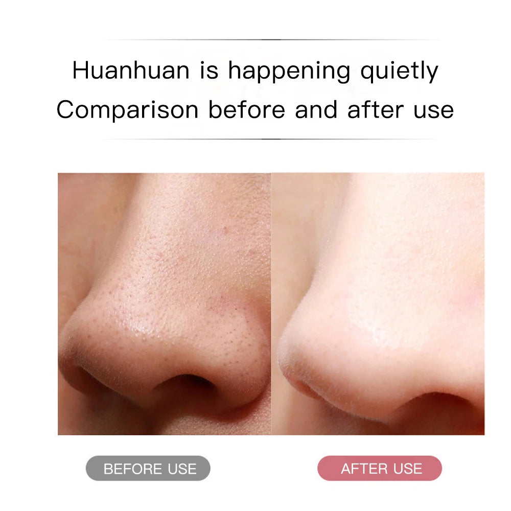 Blackhead Remover & Pore Cleaner Tool